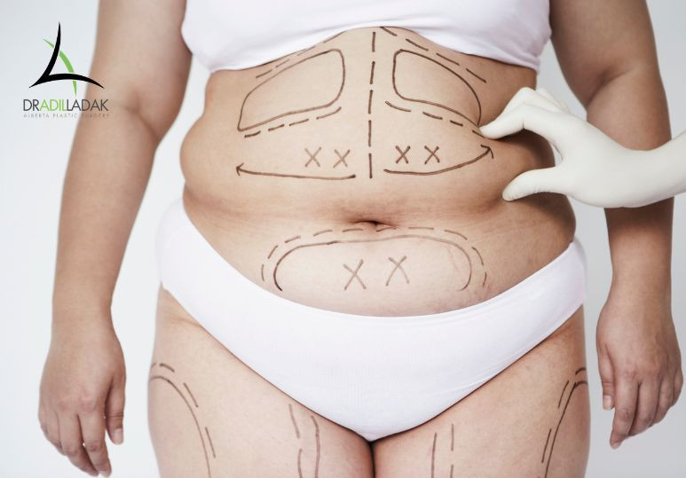 What Happens During a Liposuction Consultation – Liposuction Edmonton